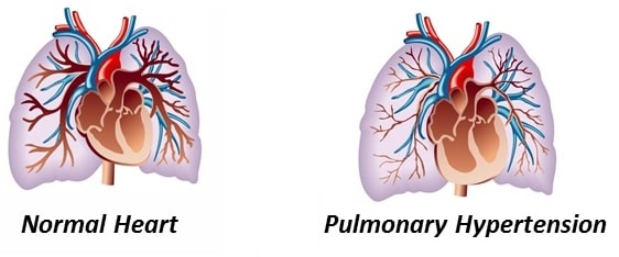 Pulmonary Hypertension Explained